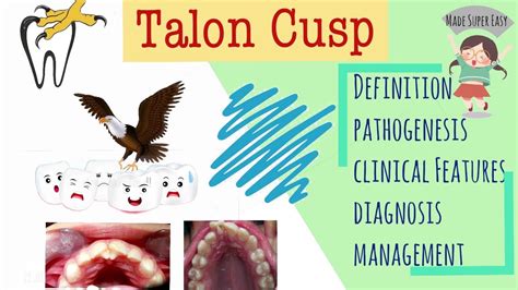 Talon Cusp I Developmental Disturbances Of Teeth Youtube