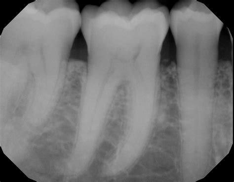 disease periodontal bone loss explained early pain process diabetes tooth stage stages molar symptoms diseases smile middle mine