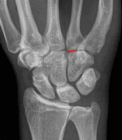 Hook Of Hamate Fracture Hand Orthobullets