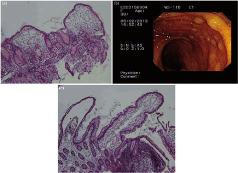A Gastric Biopsy Revealed Chronic Gastritis With Mild Lymphoplasma