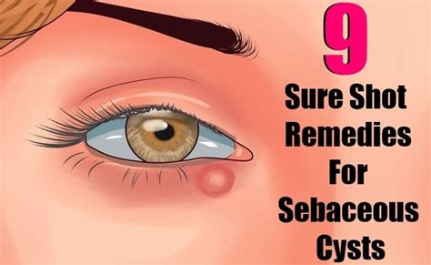 9 Sure Shot Remedies For Sebaceous Cysts Eye Cyst Remedies Cysts