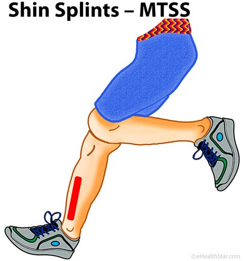 Shin Splints Causes Symptoms Treatment Prevention Stretches