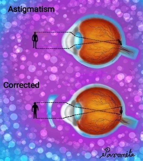 Treatment Of Astigmatism Optography