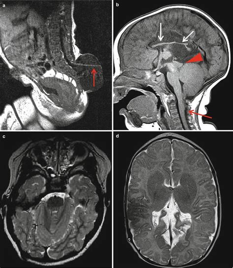 Congenital Anomalies Of The Brain And Spinal Cord Radiology Key