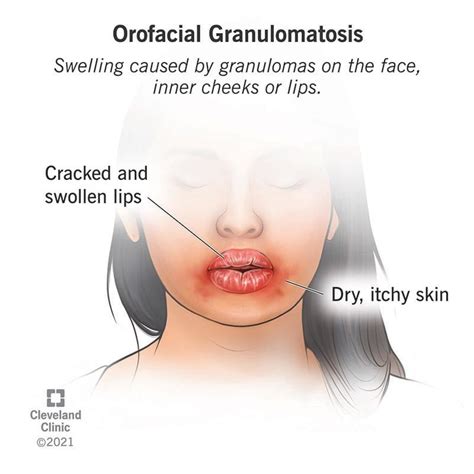 Orofacial Granulomatosis Causes Symptoms And Treatment