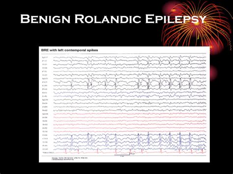 Ppt Epilepsy And Treatment Powerpoint Presentation Free Download