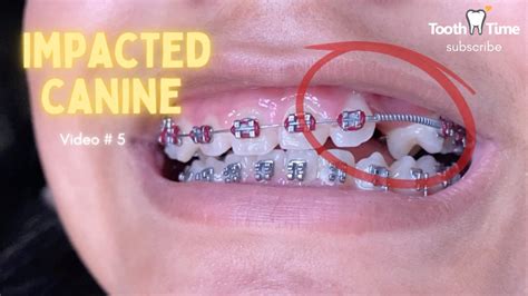 Impacted Canine Braces Treatment 6 Months Progress Video 5 Tooth