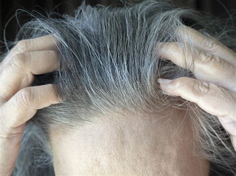 White Hair And Gray Hair Of Thai Elderly Women Hair Health Problems With Hair Loss And Thinning