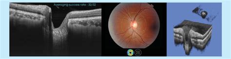 Swept Source Optical Coherence Tomography Imaging Fundus Photo