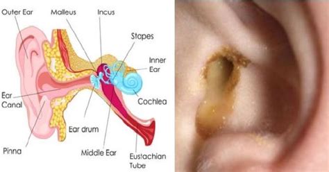 Say Goodbye To Ear Infection Heres How To Cure An Ear