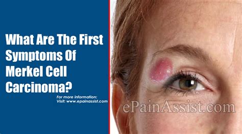 What Are The First Symptoms Of Merkel Cell Carcinoma And How Do You Test