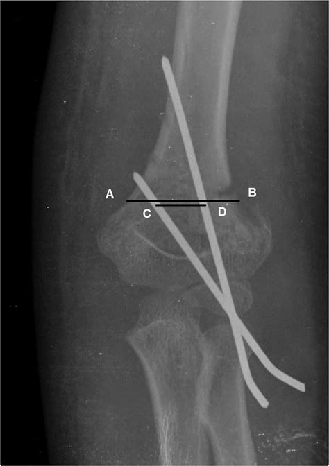 Pin Spread Measurement At The Level Of The Fracture Ab Represents The