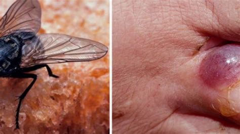 Nhs Warning As Cases Of Bloodsucking Flies Which Cause Blisters And