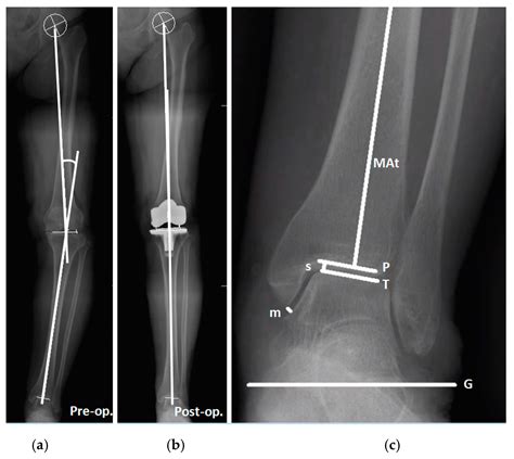 JCM Free Full Text Poor Correction Capacity Of Preexisting Ankle