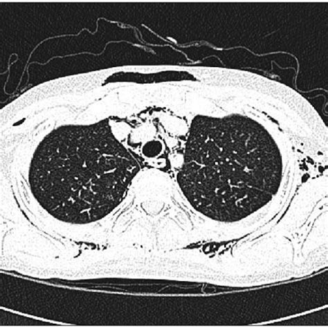 High Resolution Ct Of The Chest Showing The Subcutaneous Emphysema And