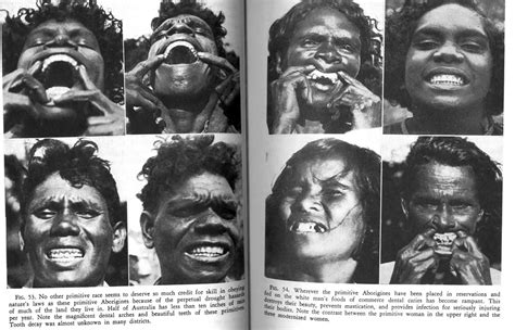 Teeth Of Australian Aborigines When Eating Their Native Diet Verses The