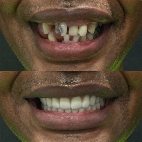 Aspen Dental Cost Of Implants