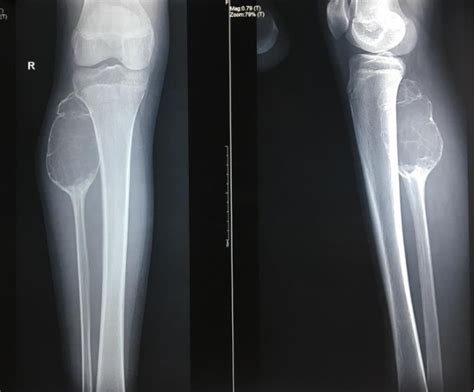 Figure 1 From Aneurysmal Bone Cyst Of Proximal Fibula Treated With En