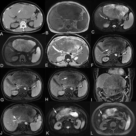 A Axial Ct View Reveals A Dominant Mass Located On The Left Lobe Of