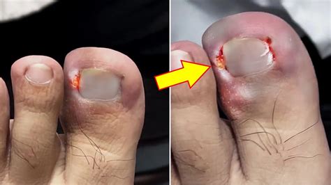 Painful Lifted Toenail Removal Nail Removal Youtube