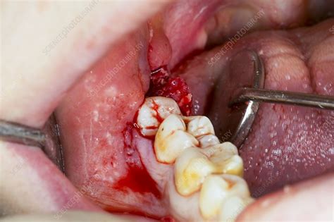 Wisdom Tooth Extraction Stock Image C0400706 Science Photo Library