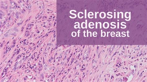 Sclerosing Adenosis Of The Breast Pathology Mini Tutorial Youtube