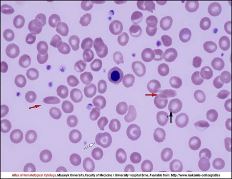 Sickle Cell Anaemia Cell Atlas Of Haematological Cytology