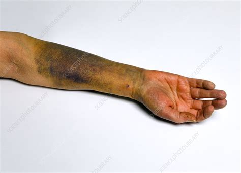 Bruised Arm Stock Image F0342599 Science Photo Library