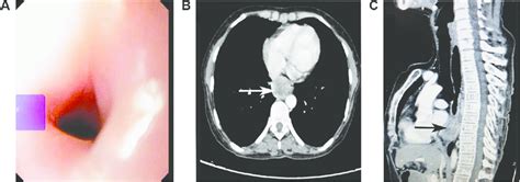 Upper Gastrointestinal Endoscopy Reveals A Smooth Stricture With Normal