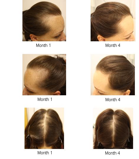 Around 40% of women by age 50 show. female pattern hair loss - pictures, photos