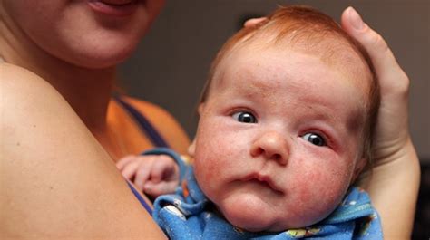Baby Eczema Atopic Dermatitis On Your Infant