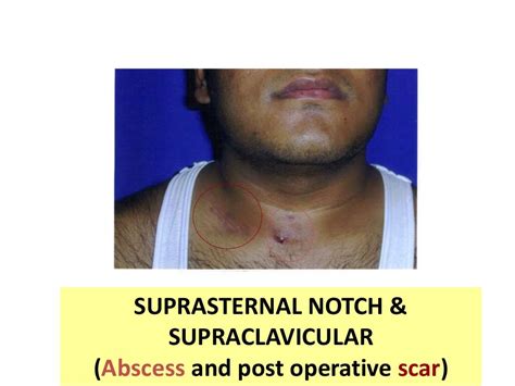 Tubercular Lymphadenitis Management