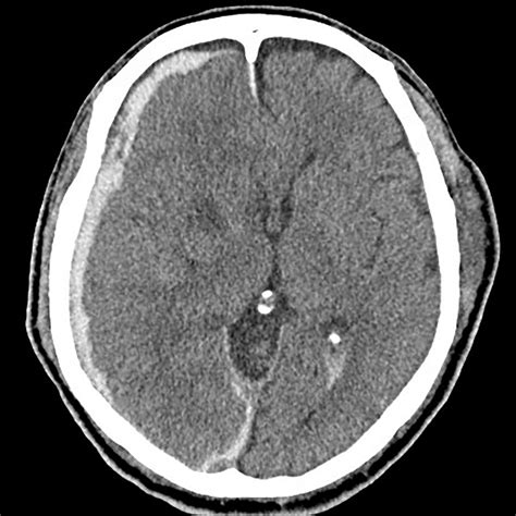 Computed Tomography Ct Showing Acute Subdural Hematoma In The Right