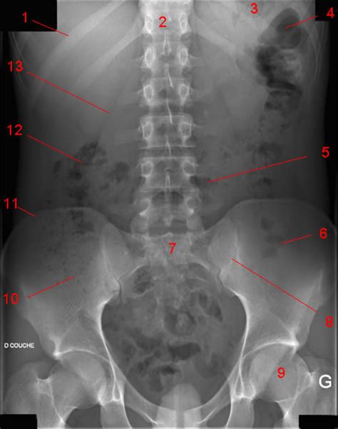 Radiology Pregnancy Infection And Treatment Xray Of Some Part Of The