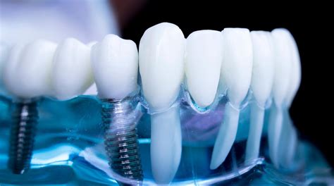 Dental implant training coming to Portsmouth - Dentistry.co.uk