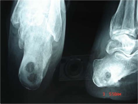 Gaenslens Split Heel Approach For The Treatment Of Chronic