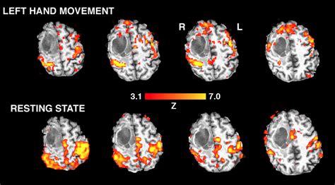 Active And Passive Fmri For Presurgical Mapping Of Motor And Language