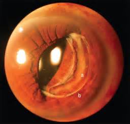 Bilateral Spontaneous Anterior Dislocation Of Intraocular Lens With The