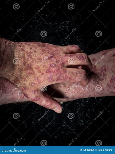 Psoriasis Eczema On The Foot Man Itching Skin Psoriasis Scales Are