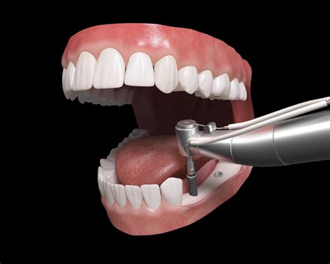 Qué es un implante dental Marfilden