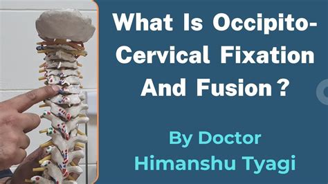 What Is Occipito Cervical Fixation And Fusion Youtube