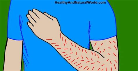 Left Arm Numbness Or Tingling Causes And Home Treatments