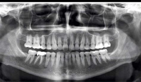 Tipos De Radiografia En La Odontología Nart Clínica Dental