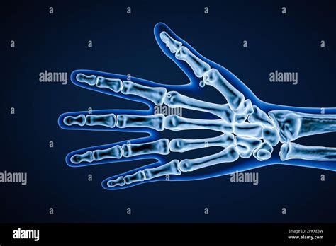 X Ray Palmar Or Anterior View Of Right Human Hand Bones With Body