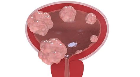 Combination Immunotherapy Shows Promise For Bladder Cancer