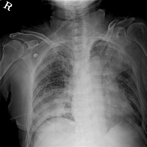 Lobar Bronchial Rupture With Persistent Atelectasis After Blunt Trauma