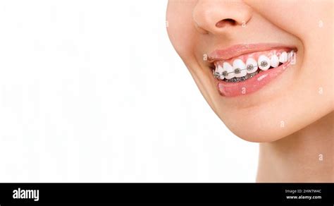 Smile With Braces Orthodontic Treatment Dental Care Concept Beautiful Woman Healthy Smile