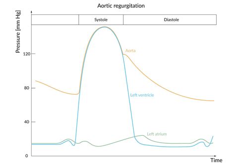 Wiggers Diagram Aortic Regurgitation