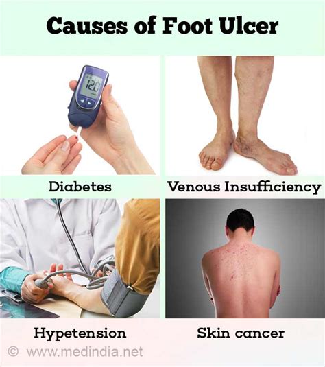 Diabetic Foot Ulcer Causes