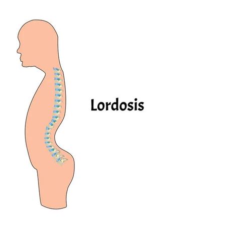 The Position Of The Spine With Lordosis Spinal Curvature Kyphosis